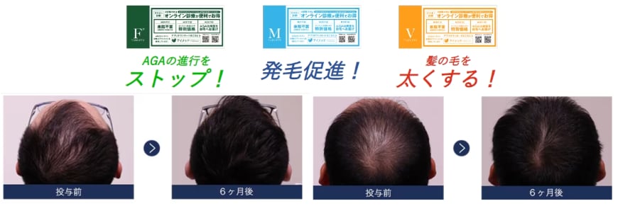 AGA治療薬（薄毛治療薬）とは