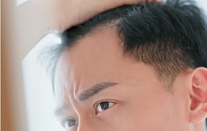そもそも”AGA”とはなんですか？