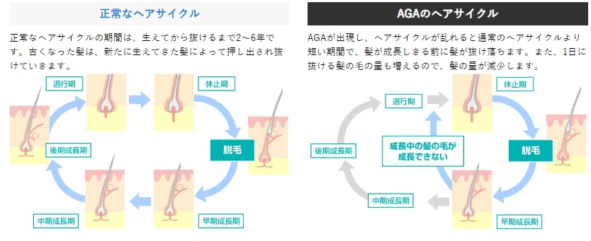 AGAの原因は？