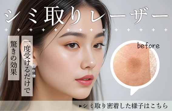 【シミ取り】シミのない美肌へ！
