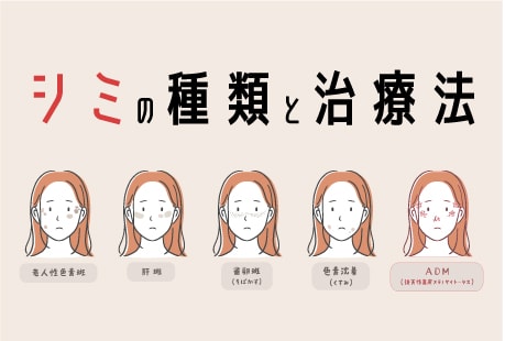 【医師監修】種類別、正しい別シミの取り方とは？埼玉でシミ取りなら最適な治療ができる湘南美容クリニック熊谷院がおすすめ！