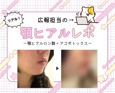 【スタッフの美容治療レポ】アゴなし、梅干しジワを改善して綺麗なフェイスライン！ヒアルロン酸&ボトックス☆埼玉の熊谷で綺麗なフェイスライン叶います。