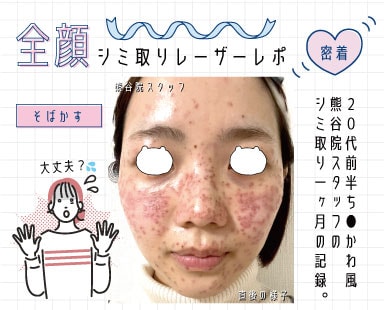 【熊谷院スタッフが顔のシミを取りまくったら大変なことに！？】埼玉でシミ取り放題なら湘南美容クリニック熊谷院！【そばかす】
