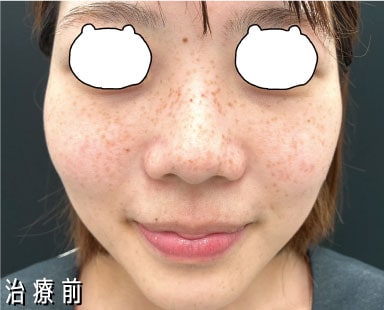 治療前