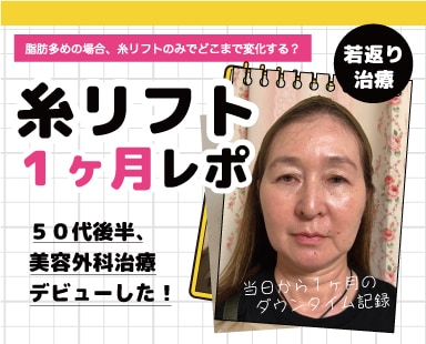 【糸リフト1ヶ月密着】糸リフトのみでどのくらい変化する？【脂肪多め50代後半女性の全顔モニター】熊谷で切らずにリフトアップなら湘南美容クリニック熊谷院