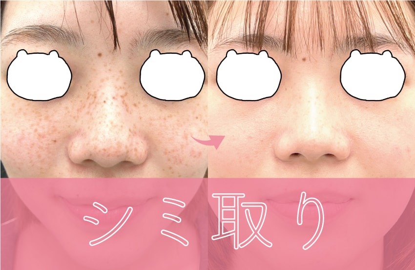 シミ取り