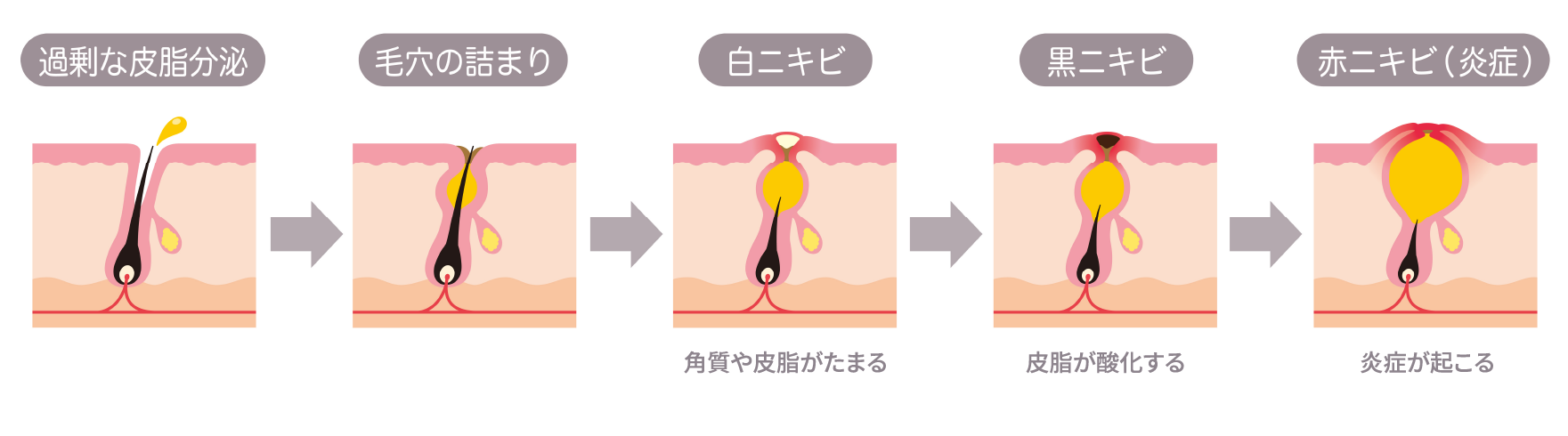 ニキビとは