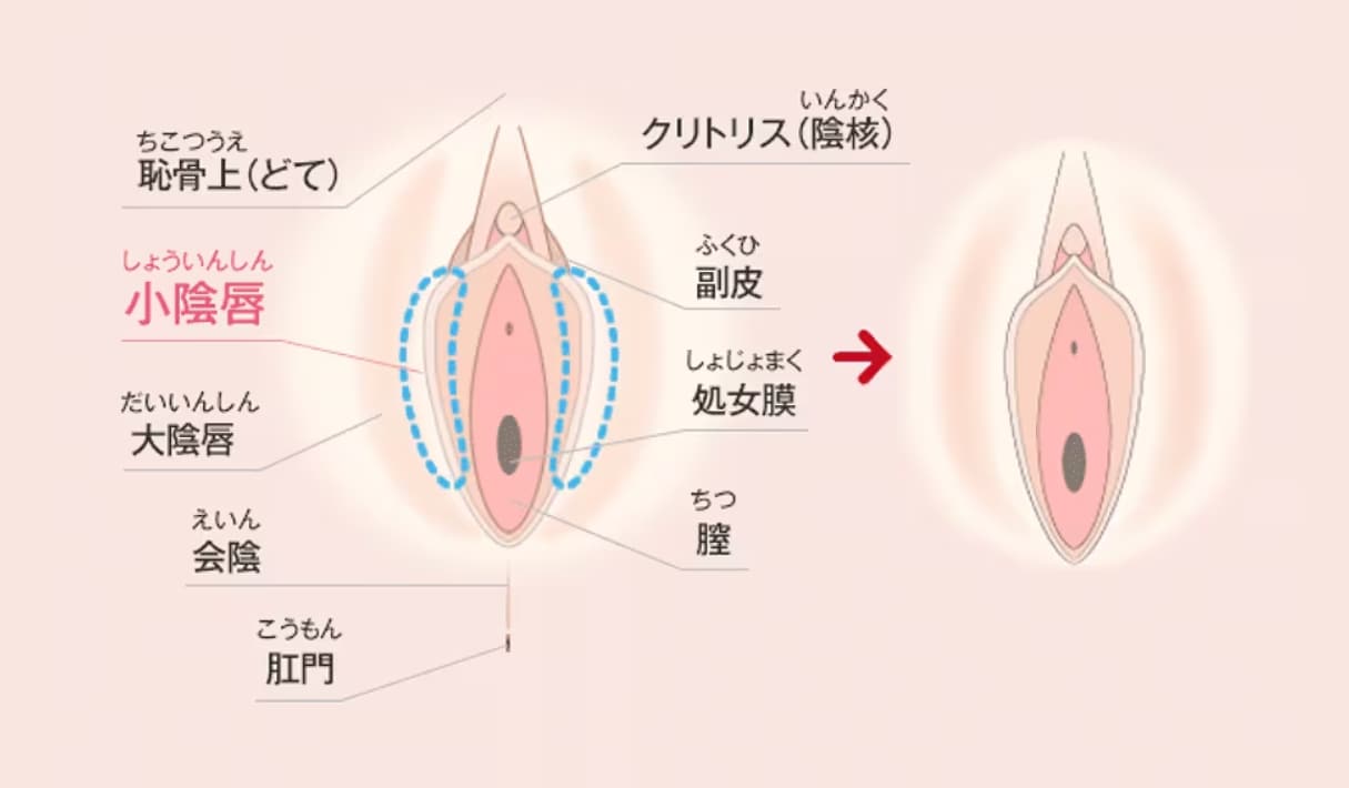 小陰唇縮小術
