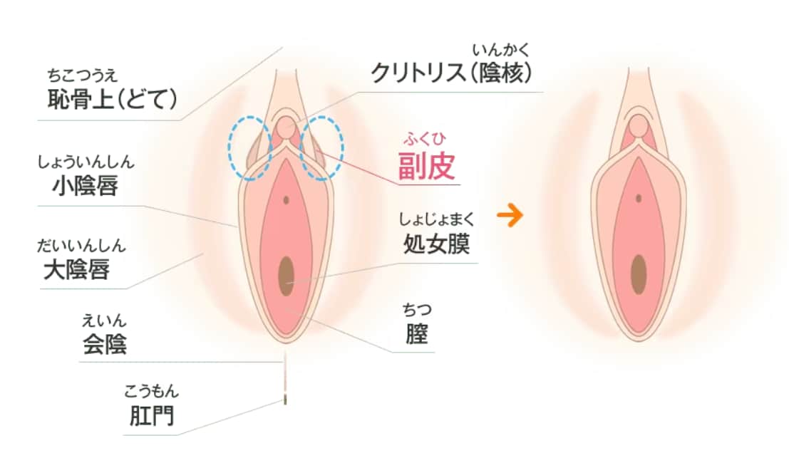 副皮除去術