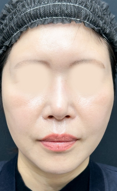 糸リフト40代女性の術後の症例写真
