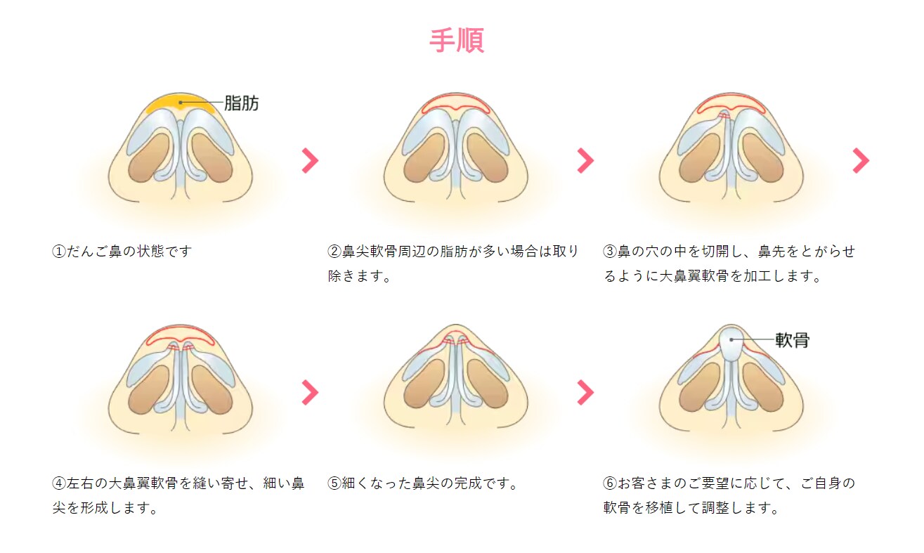 鼻尖形成(団子鼻解消術)