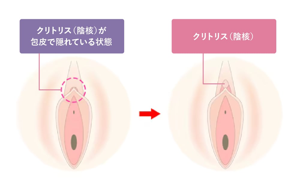 陰核包茎（クリトリス包茎）