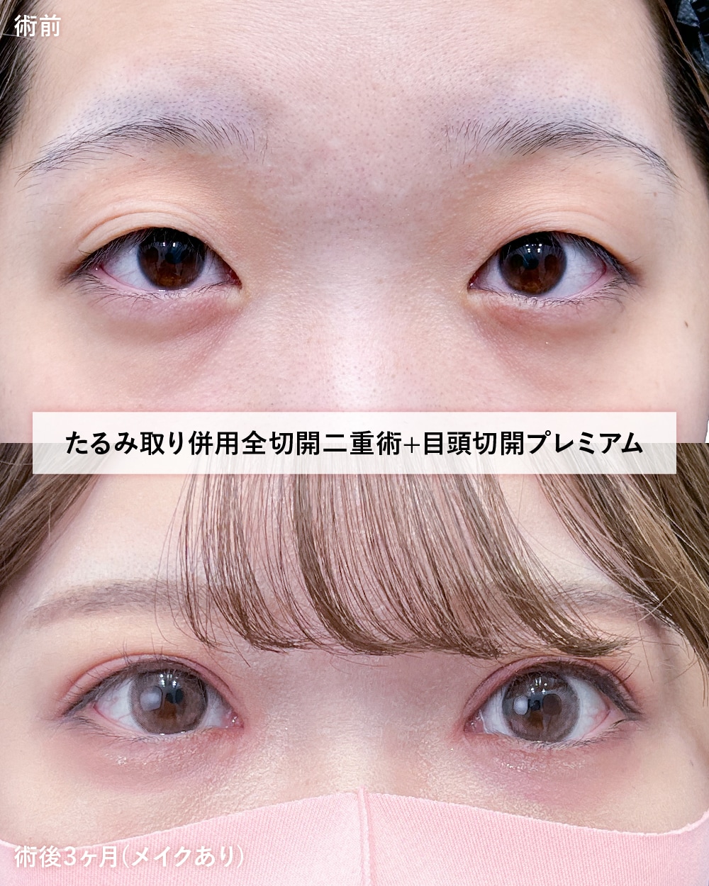 全切開二重術+目頭切開プレミアム