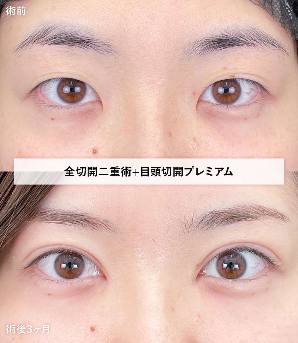 全切開二重術+目頭切開プレミアム