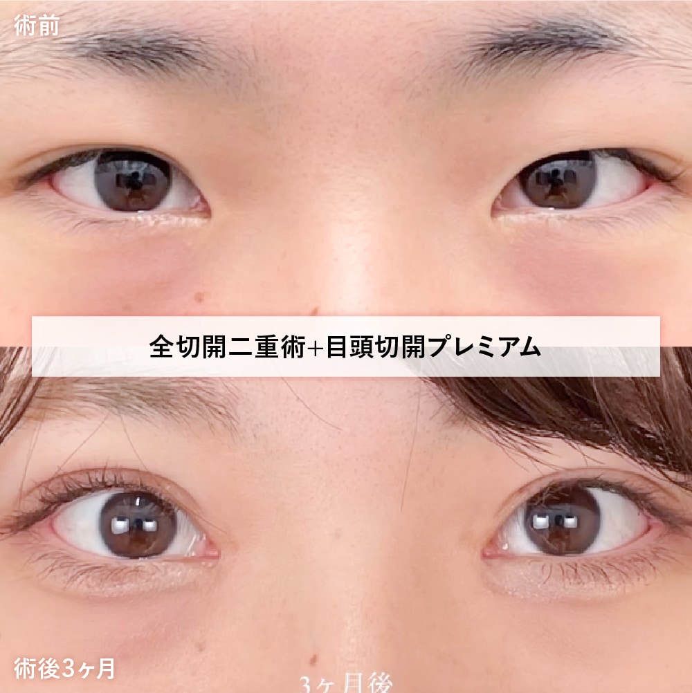 全切開二重術+目頭切開プレミアム