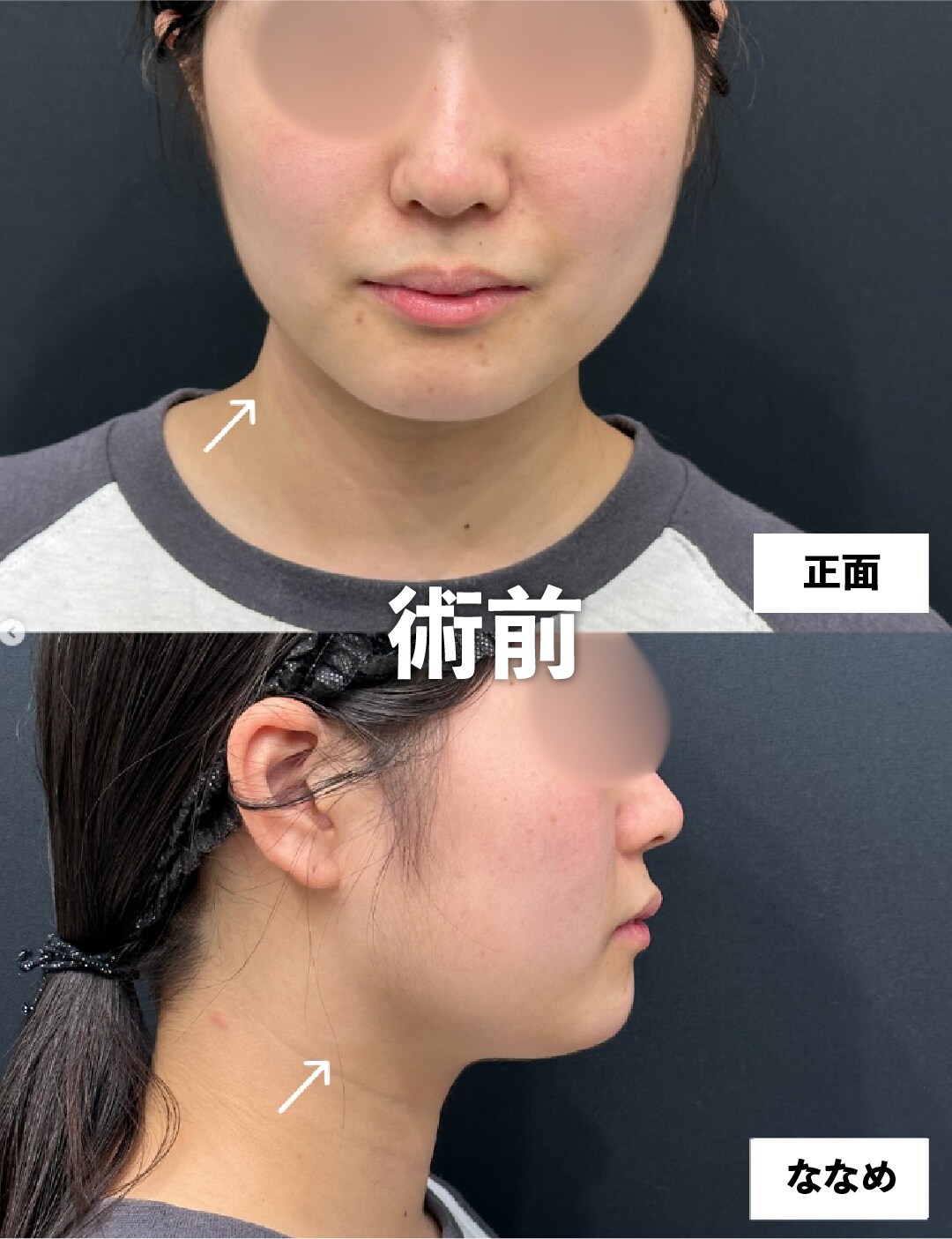 術前