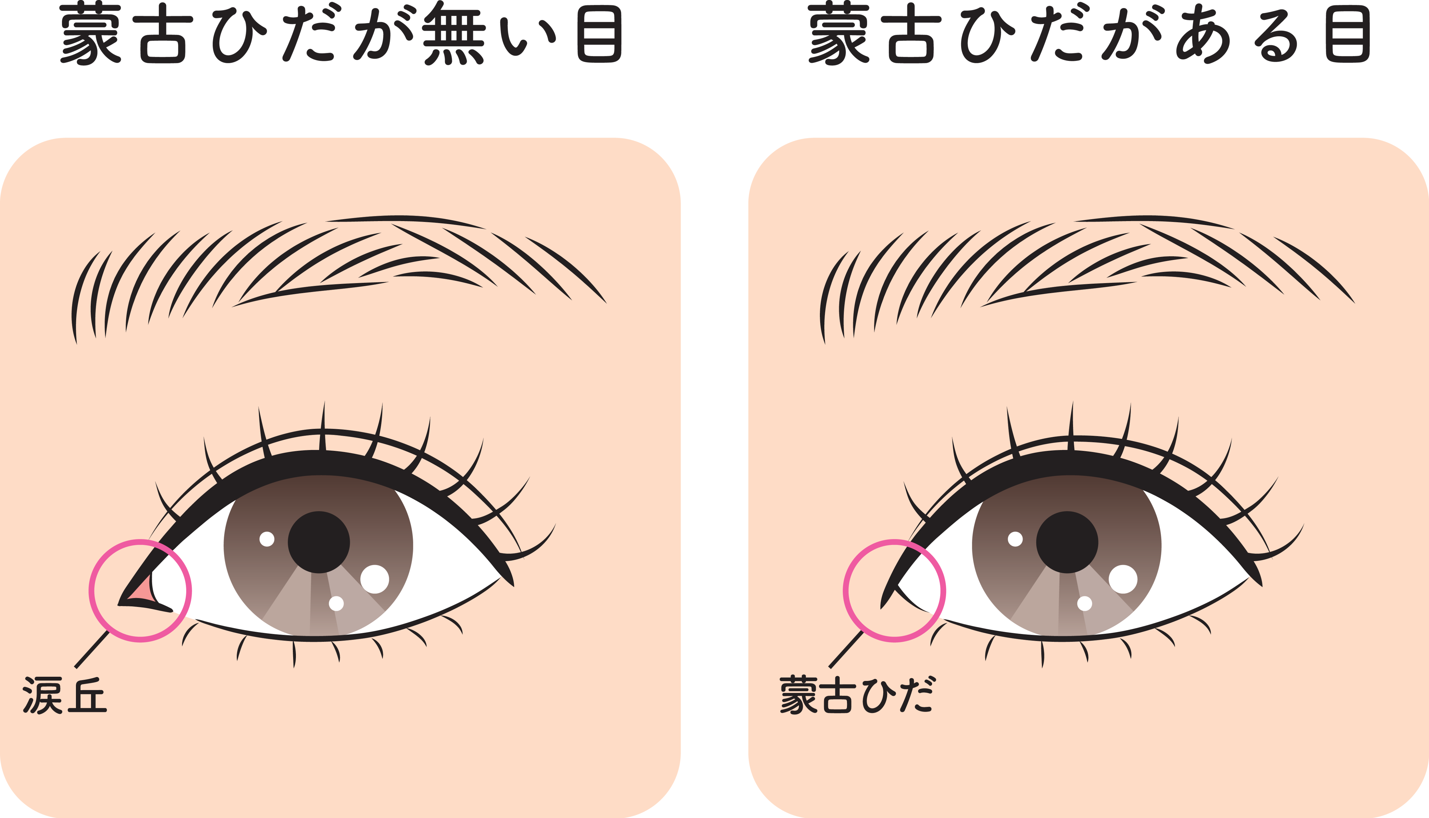 目頭切開とは