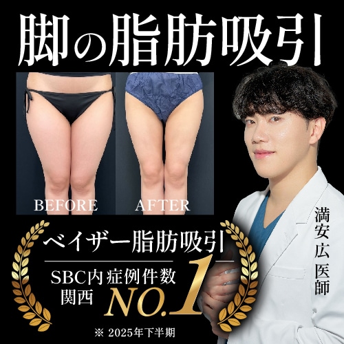 【足の脂肪吸引】太もも・ふくらはぎの太さでお悩みの方へ！SBC熊本院で解決できます♪
