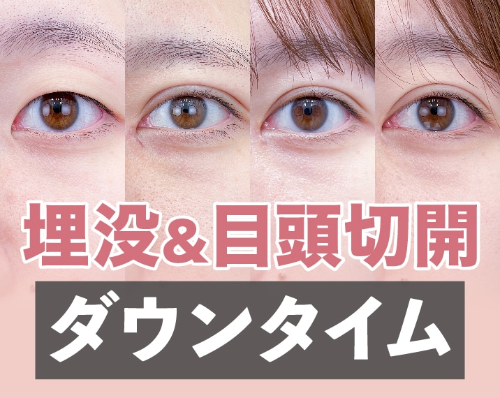 熊本｜二重埋没＋目頭切開のダウンタイムって？直後から3ヶ月まで経過を大公開！