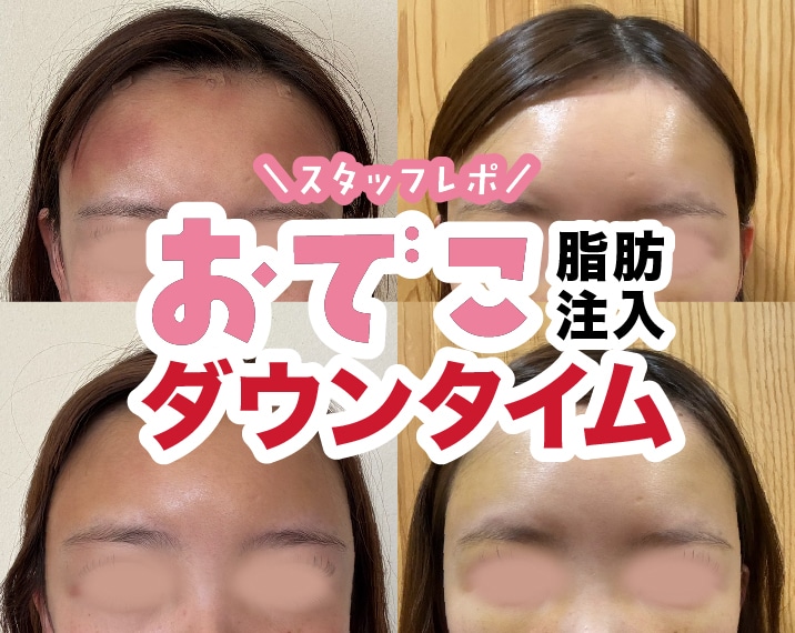 【熊本】おでこ脂肪注入のリアルな経過を大公開！スタッフの自撮りダウンタイム6日間