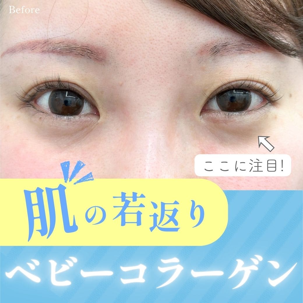 【新治療】疲れてる？ってもう言わせない！ ベビーコラーゲンが熊本院へ！気になる効果は？？