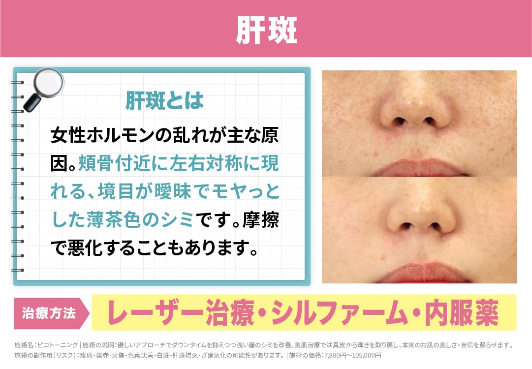 【肝斑】