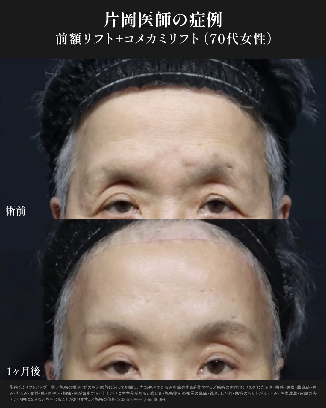 前額リフト症例写真