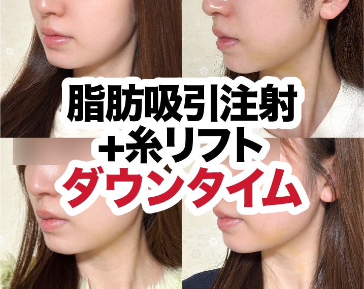 【熊本｜スタップレポ】顔の脂肪吸引注射+糸リフト ダウンタイムはどれくらい？自撮り写真で経過を大公開！