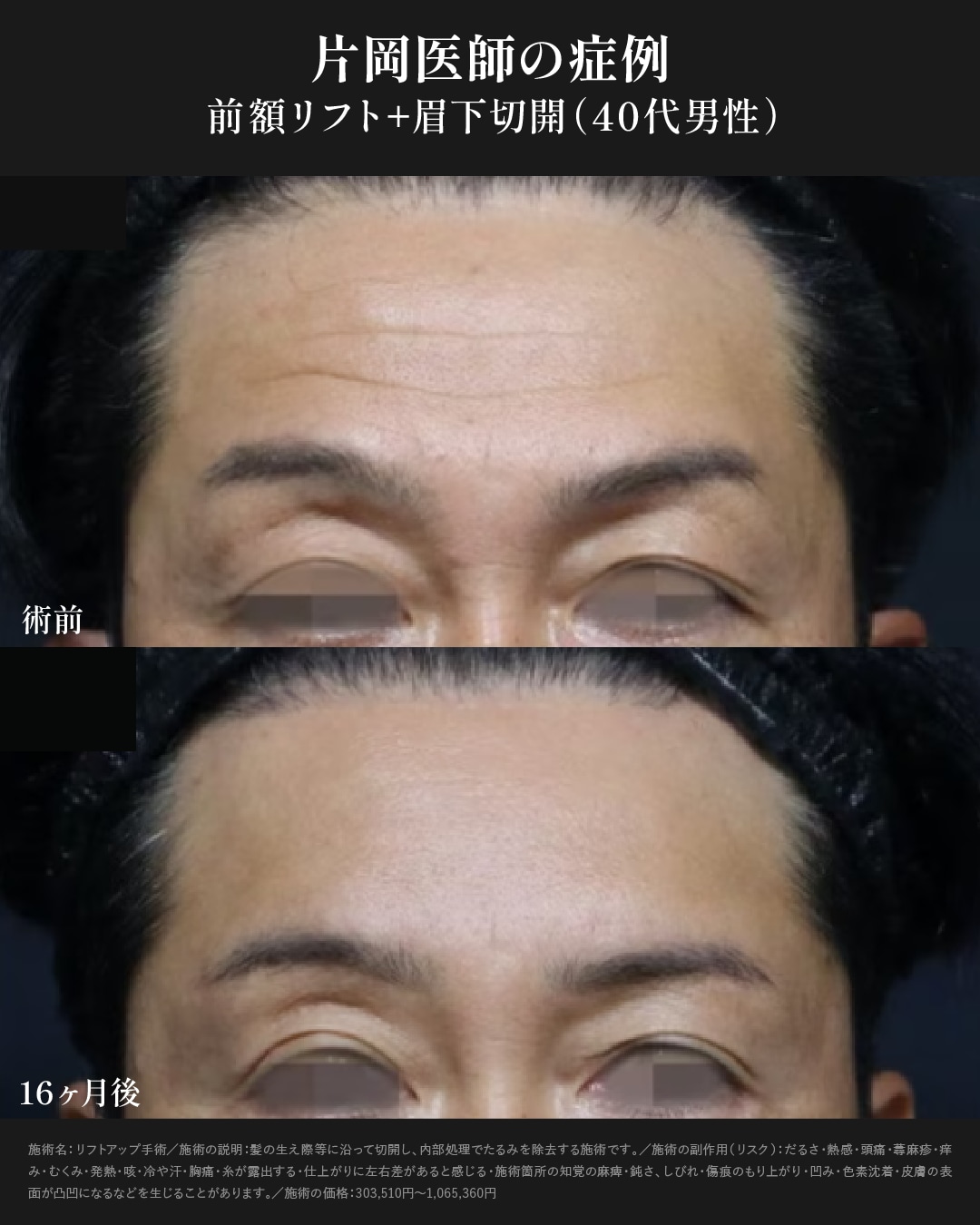 前額リフト症例写真