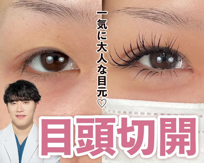 【熊本】目頭切開で垢抜け！