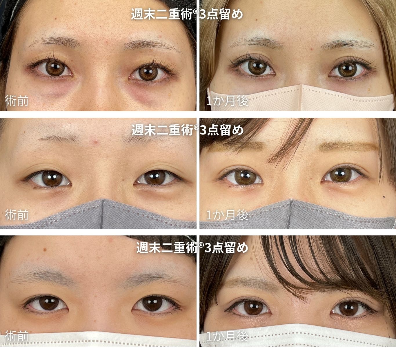週末二重術®