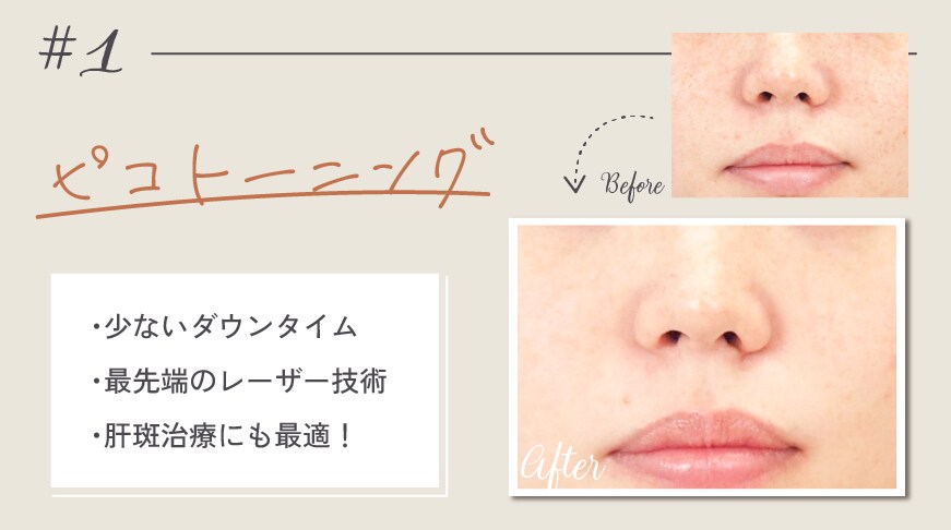①ピコトーニング