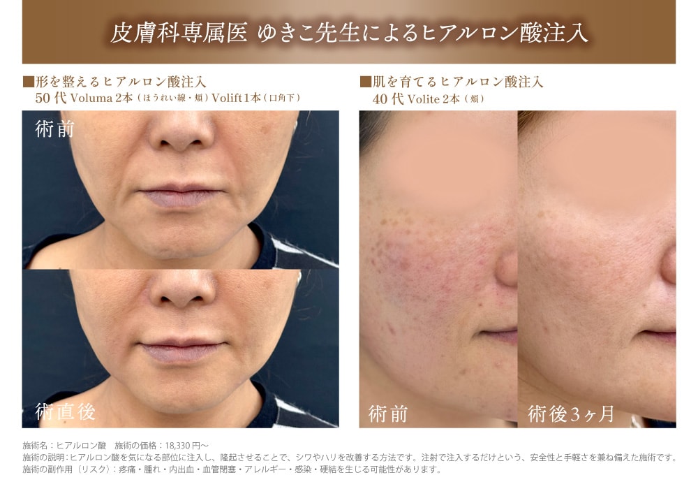 あなたはどっち？【ヒアルロン酸】で肌育 or 輪郭補正