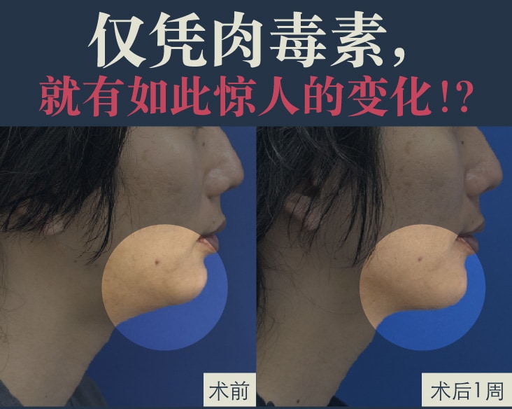 【★院长亲身体验★】仅靠肉毒竟然能有这样的变化！在京都站大楼院实现几乎零恢复期的小脸・提拉术【肉毒素提拉】