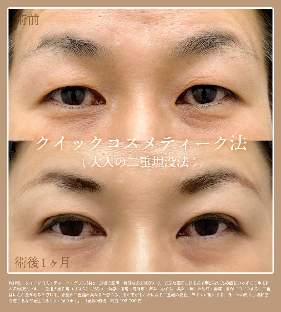 症例写真 | 京都で埋没のご指名多数【切らないまぶたのリフトアップ】
