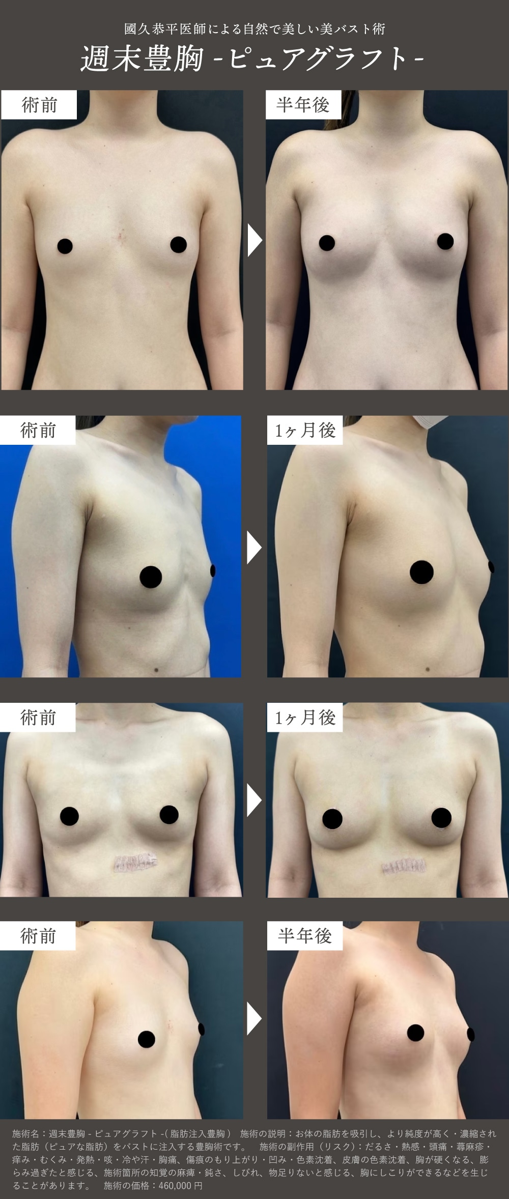 京都で美バストなら國久医師の脂肪注入豊胸！<br />
