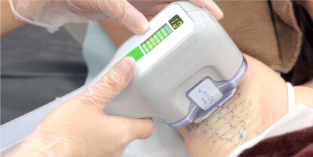 切らないワキガ治療
