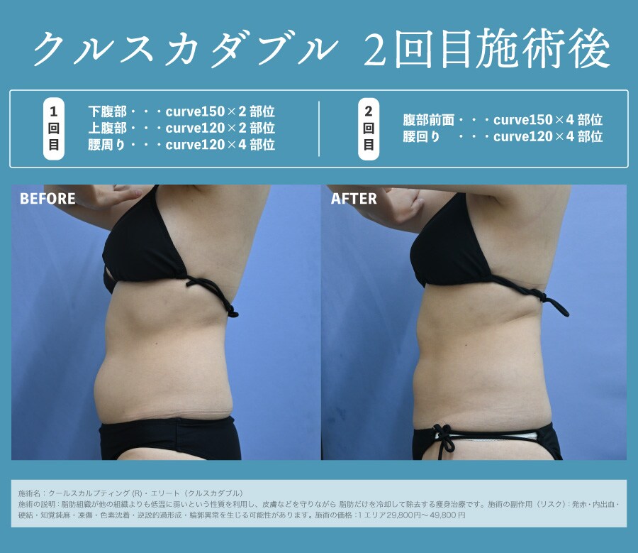クルスカダブル2回目施術後