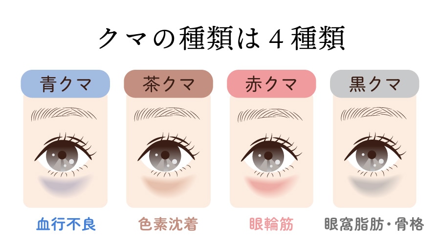 あなたの目の下のクマはどのタイプ？
