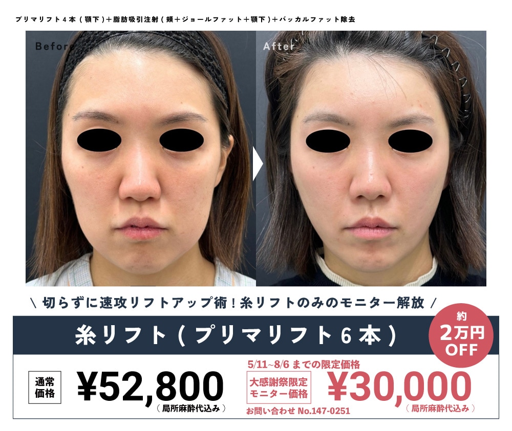 0511外科CP価格_2605_5周年モニターCP_糸リフト