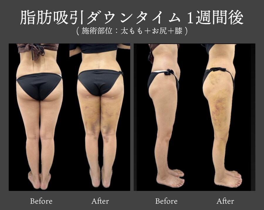 脂肪吸引のダウンタイム