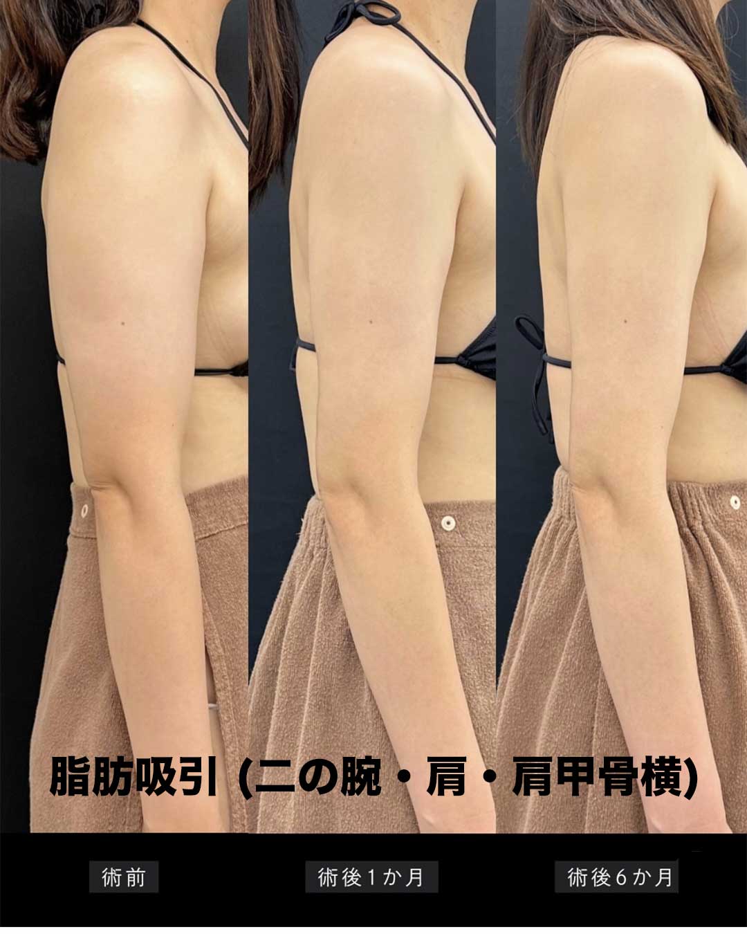 二の腕・肩の脂肪吸引でノースリーブの似合う腕に
