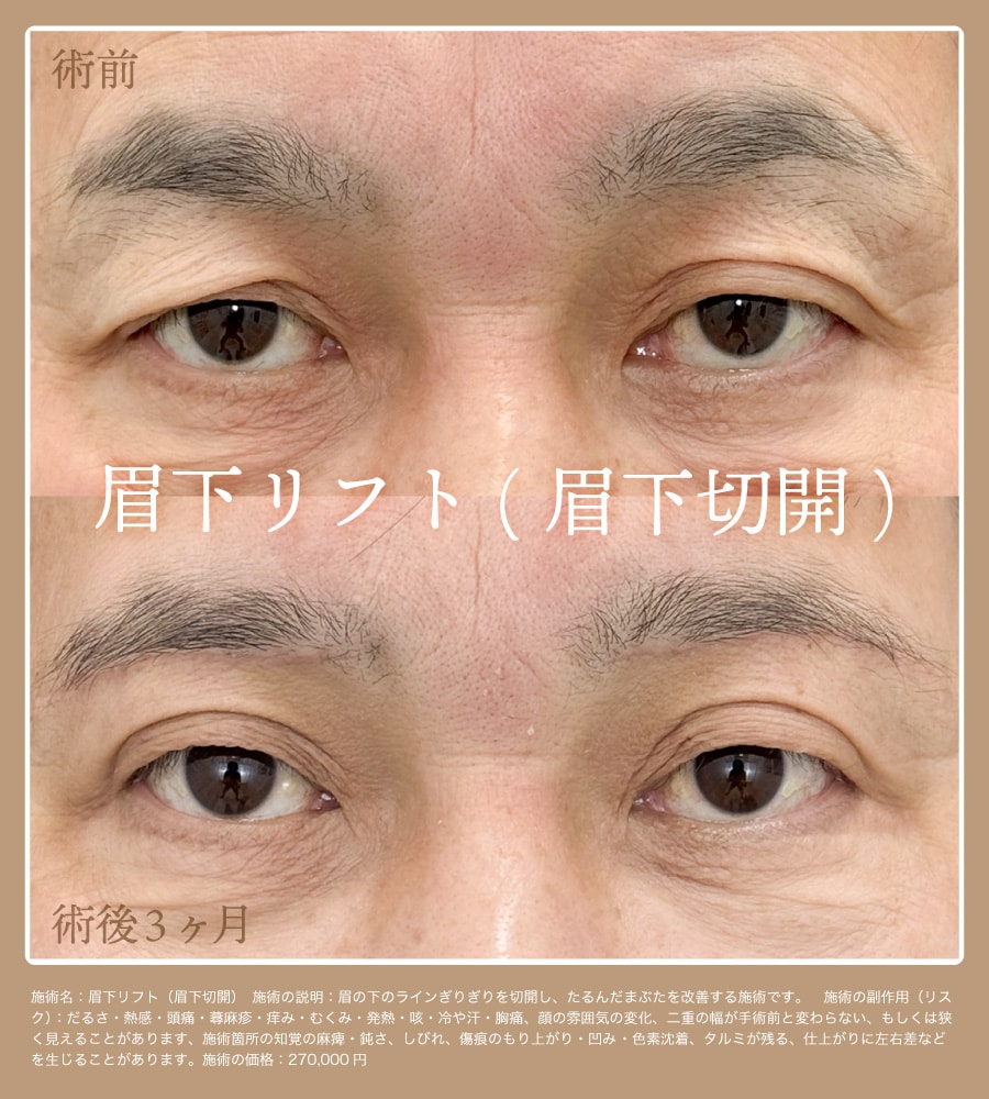 症例写真 | 京都で選ばれる目元の若返り【眉下リフト】