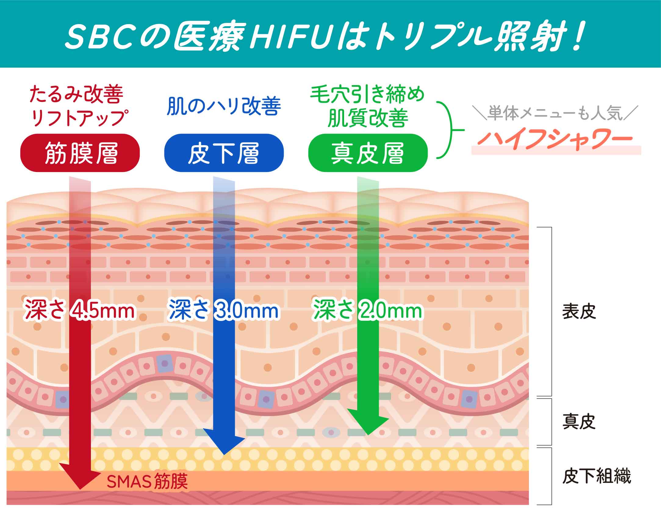 医療ハイフ(HIFU)の仕組み<br />
