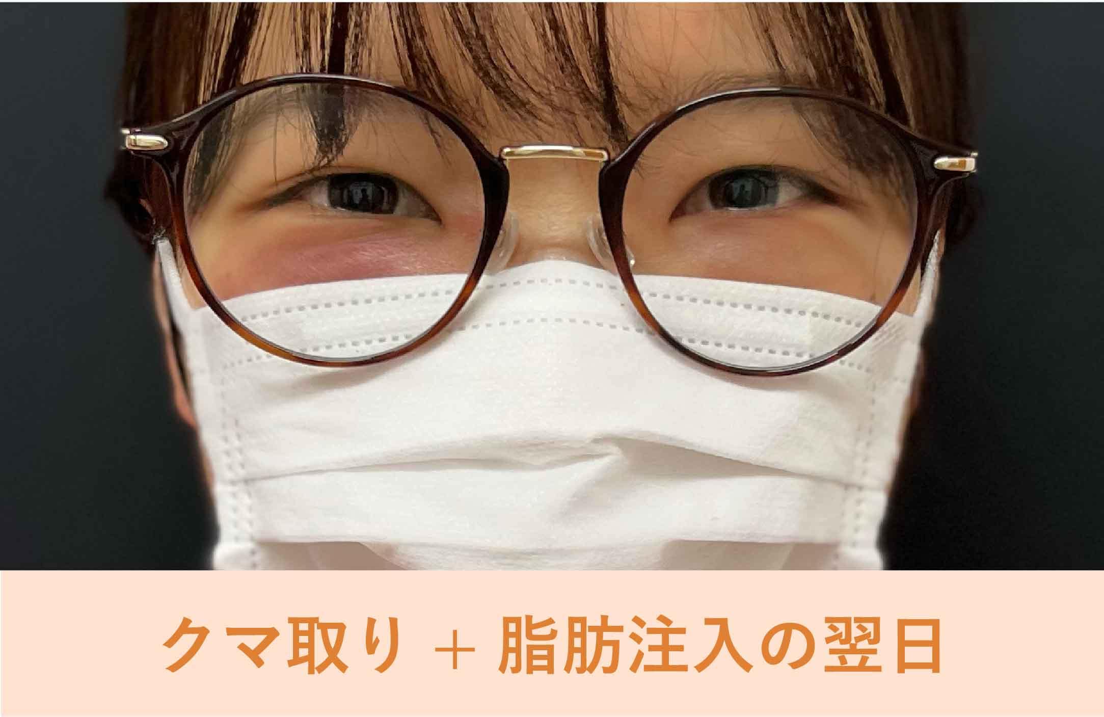 実際のダウンタイムと過ごし方
