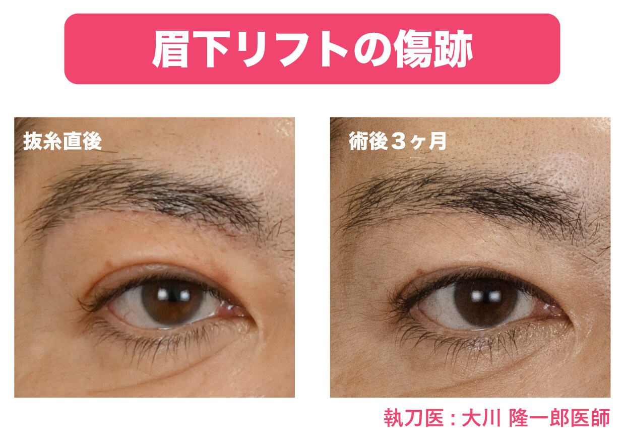 眉下リフトの傷跡