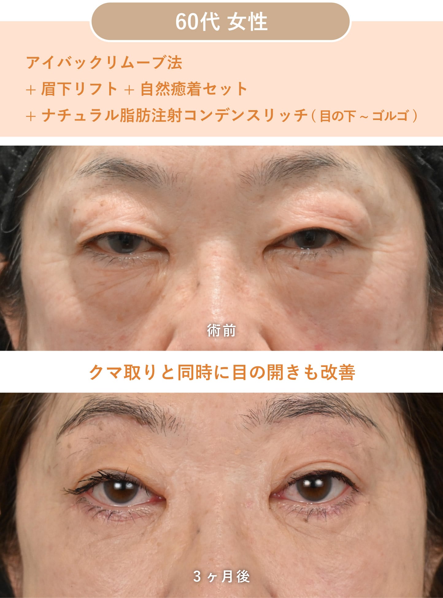 目の上のたるみ・開きも同時改善。<br />
「切る」「切らない」選べるスペシャリスト