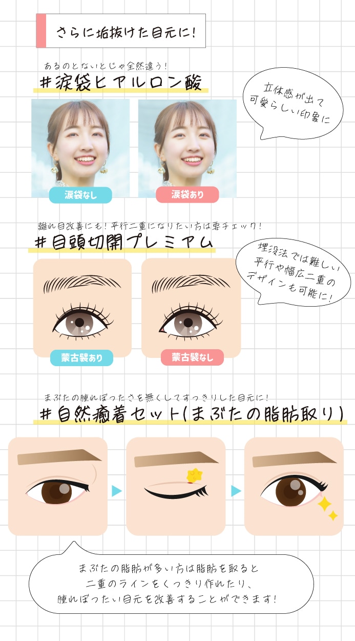 埋没だけじゃない！垢抜け二重のための美容整形