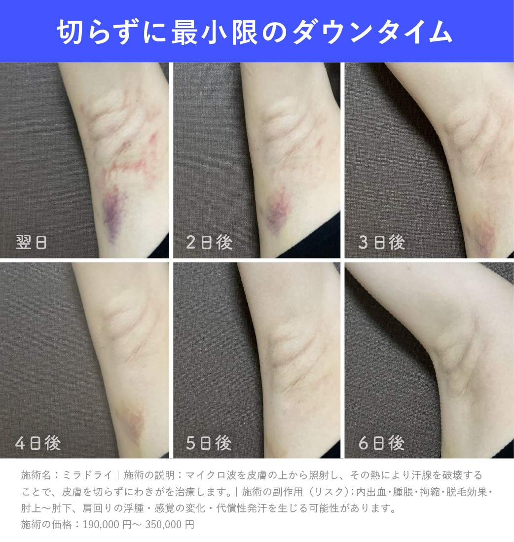 【症例】<br />
気になるミラドライのダウンタイム