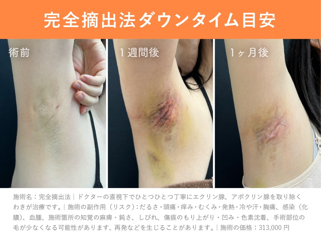 【症例】<br />
気になるダウンタイムは？
